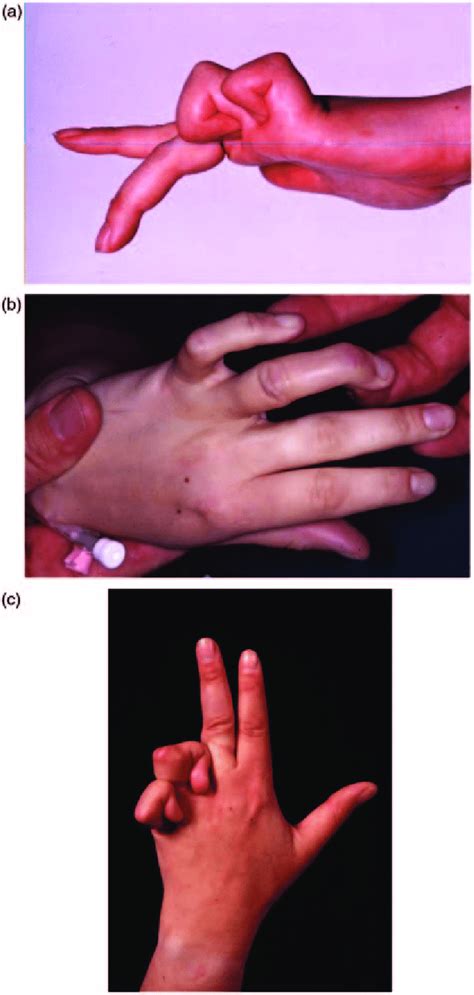 A Contractures 2 Years After Ulnar Nerve Decompression B Extension