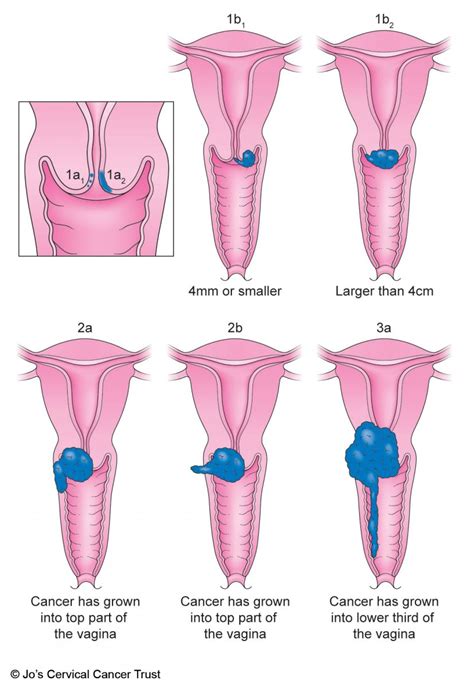 While cervical cancer cases fell by about 1% per year, other types rose. Grading and Staging Cervical Cancer | Jo's Cervical Cancer ...