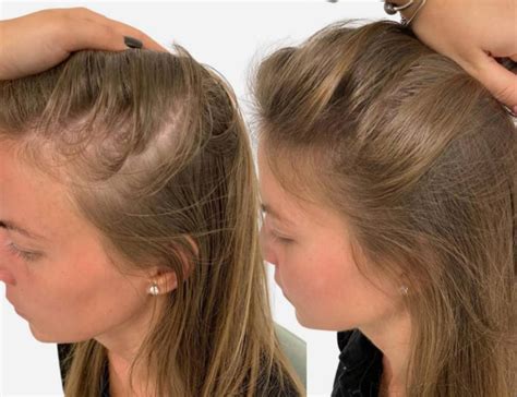 Hair Loss In Women Female Hair Loss Treatment Birmingham