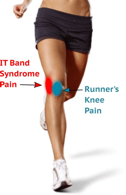 Whats The Difference Between It Band Syndrome And Runners Knee