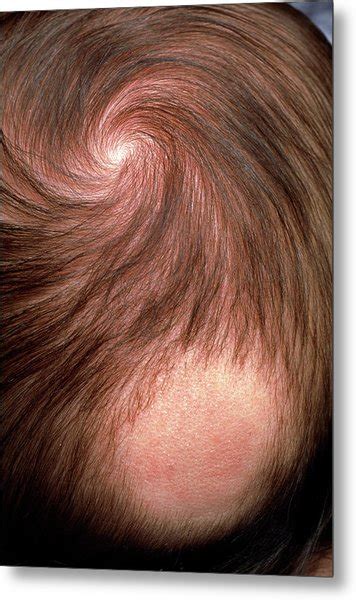 Bald Patch On The Back Of 3 Month Old Babys Head Photograph By Pascal