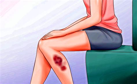 Here Are Health Problems That Will Justify Inexplicable Bruises On Your Body Bestoknow