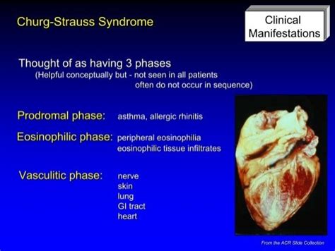 Churg Strauss Syndrome Di
