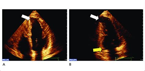 A Real Time Four Chamber Window Showing Apical Diskynesia Arrow With