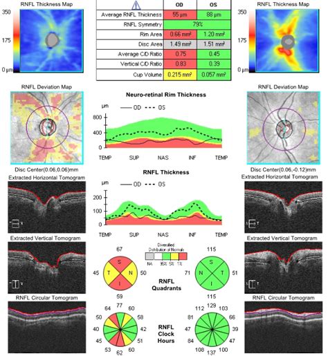 Optical Coherence Tomography Oct Applecross Eye Clinic
