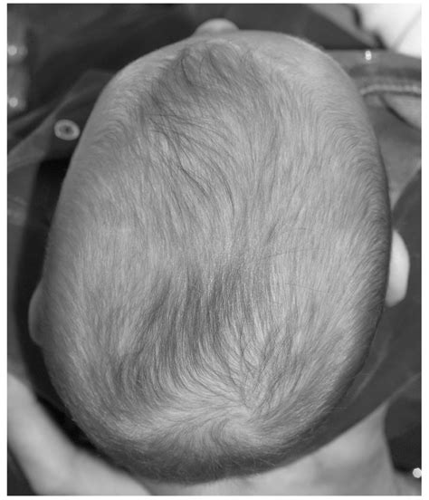 Deformational Plagiocephaly With Typical Manifestations Including A
