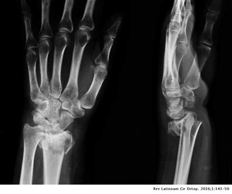 Fracturas Del Extremo Distal Del Radio Resultados Funcionales Y