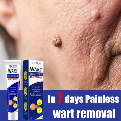20g sefudun warts remover cream warts magic remover wart treatment warts removal ointment cream