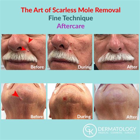 Scarless Mole Removal Gk Dermatology Pc
