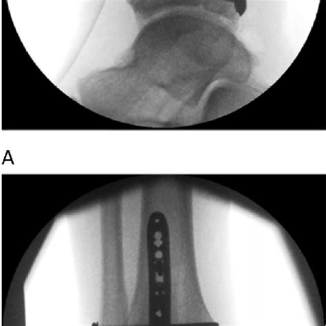 Pdf Direct Fixation Of Fractures Of The Posterior Pilon Via A