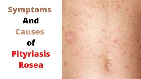 Pityriasis Rosea Foods To Avoid Its Symptoms And Causes