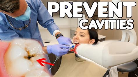 5 Simple Ways To Prevent Cavities Youtube