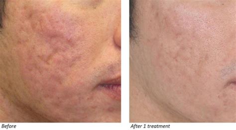 Acne Scar Treatment With Co Laser