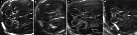 Fourth Ventricle Index Sonographic Marker For Severe Fetal Vermian
