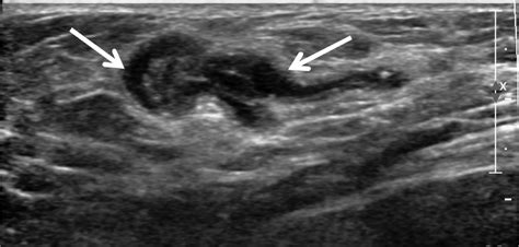 After 6 Months Ultrasound Shows A Well Defined Hypoechoic Tubular