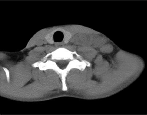 Ct Scan Of Neck Showing An Ill Defined Lobulated Mass In The Left Side