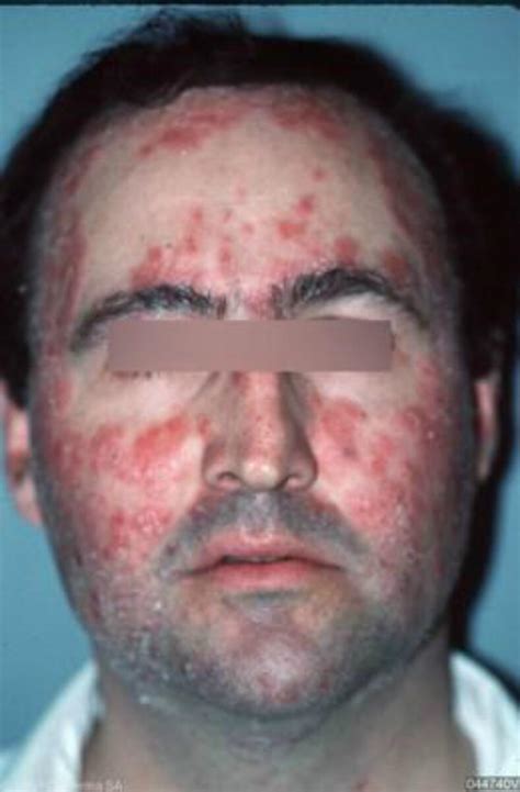 Psoriasis Facial Psoriasis