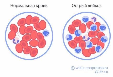 Онко Вики — Что такое острый лимфобластный лейкоз? Картинка - Онко Вики — Что такое острый лимфобластный лейкоз?