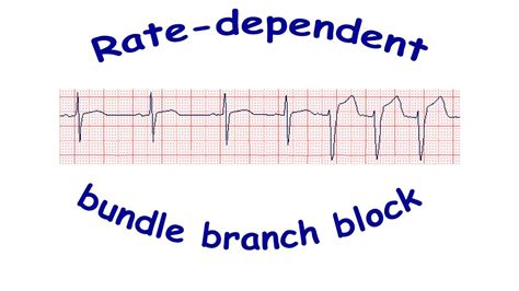 A Functional Bundle Branch Block Means Which Of The Following