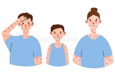 Sintoma Do Vírus Monkeypox Em Doentes Com Febre Dor De Cabeça Inchaço