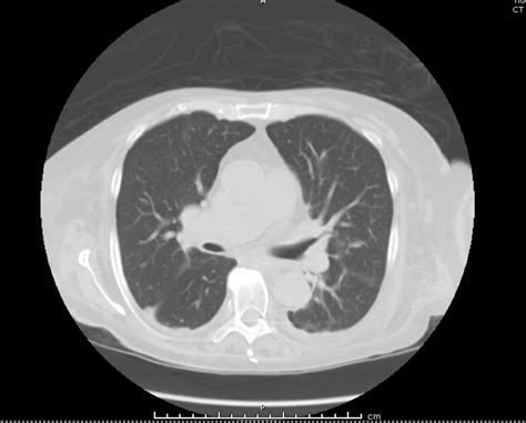 Cureus The Rash The Weakness And The Nephritis Nerve And Kidney