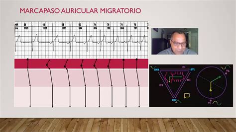 Marcapaso Auricular Migratorio Mecanismo Electrocardiograma Y