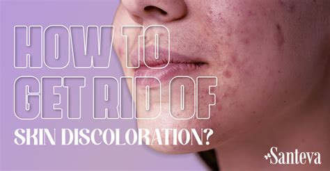 How To Get Rid Of Skin Discoloration Santeva