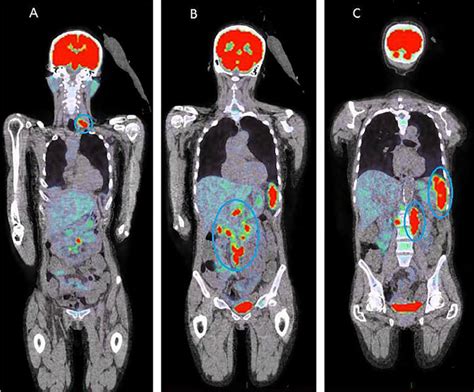 The pet scan images help to know more about the size, shape, position. An overview about PET CT scans in a nutshell - PrzeSpider