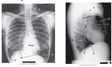 Chest Radiographic Anatomy Diagram Quizlet