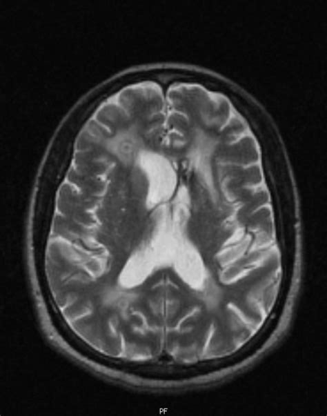 Ct Scan Of The Brain Showing Two Lesions With A Ring Shaped