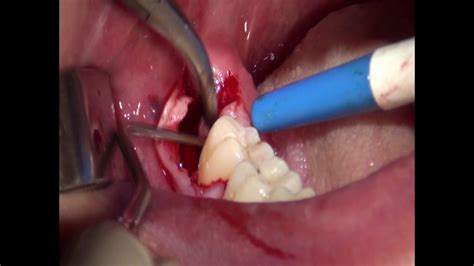Wisdom Tooth Extraction Youtube