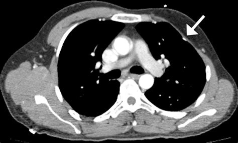 Us And Mr Imaging Of Pectoralis Major Injuries Radiographics