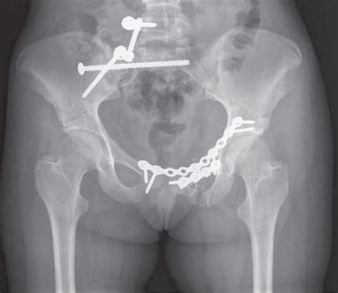 Pelvic Fractures Orthoinfo Aaos