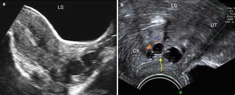ultrasound evaluation of the cervix obgyn key