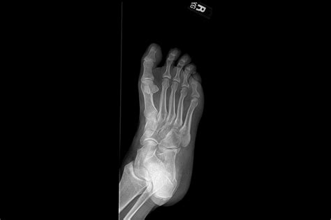 Ortho Dx Pain Following A Twisted Ankle Clinical Advisor