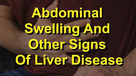 Abdominal Swelling And Other Signs Of Liver Disease Youtube