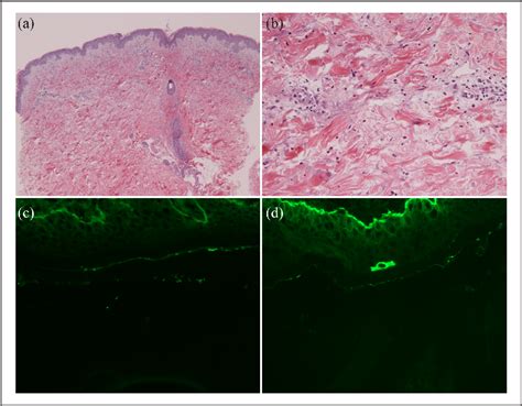 Pdf A Case Of Drug Induced Bullous Pemphigoid Secondary To