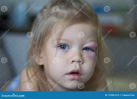 Portrait Of Caucasian Child Of Two Years Old With The Bruise On Face On
