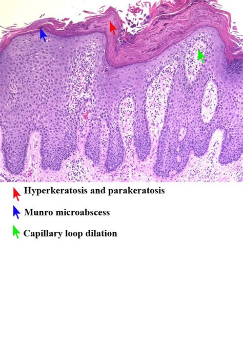 Psoriasis Pathophysiology Wikidoc