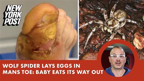 Wolf Spider Lays Eggs In Mans Toe Baby Hatches Inside ‘eating Its