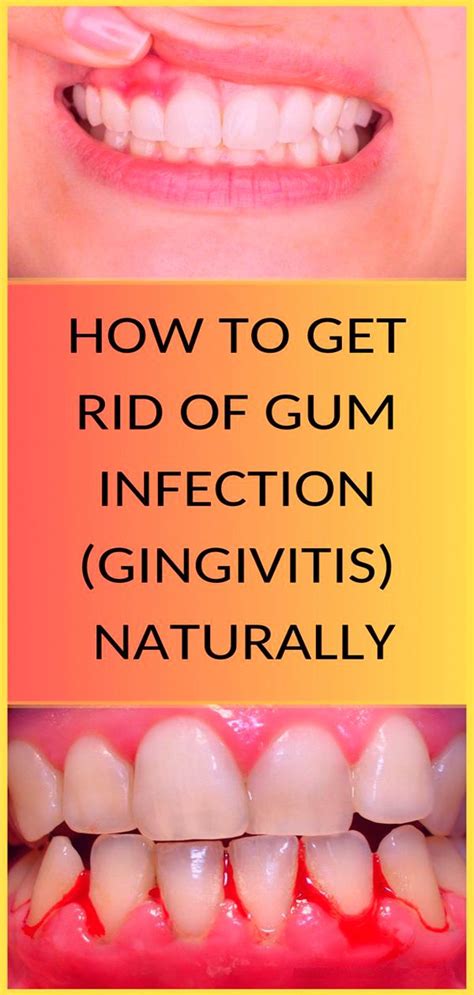 How To Get Rid Of Gum Infection Gingivitis Naturally Gingivitis Is