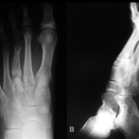 Intraoperative Radiographs Of The Lesion Following Repair And