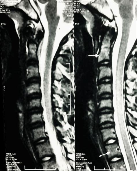 Plain X Ray Cervical Spine Showing Loss Of Cervical Lordosis
