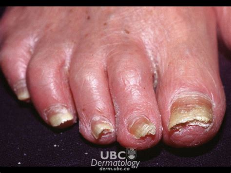 Cspa Overview What Are Nail Disorders