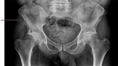 Pelvic Bone X Ray