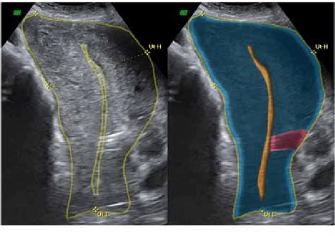 Sagittal View Of The Uterus With Highlighted Margins Download