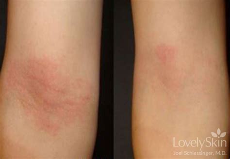 Omaha Dermatology Eczema Treatments Skin Specialists Pc Lovelyskin™
