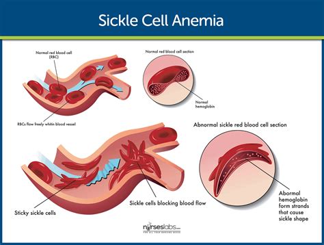 Sickle Cell Anemia Nursing Care And Management Study Guide