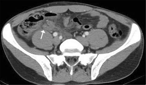 Abdominal Ct Scan In The Right Lower Quadrant Remnant Appendix Tissue