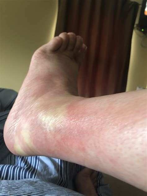 Small Itchy Bumps On Ankles Vrogue Co